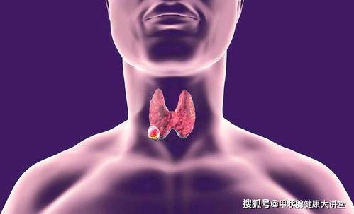 养生堂甲状腺结节视频,甲状腺结节防治之道