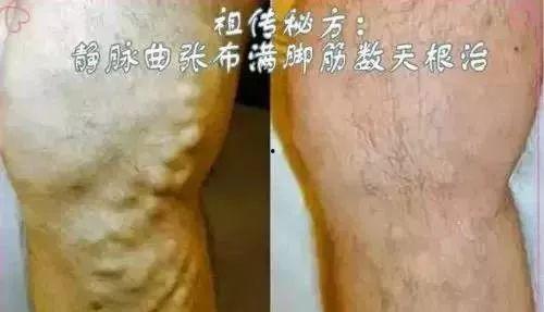 火针治疗静脉曲张视频,传统中医与现代视角的融合