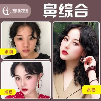 鼻子微整视频,揭秘鼻子微整视频中的神奇蜕变